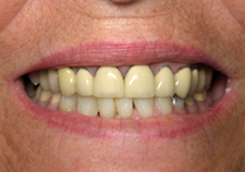 Dental Implants Before Picture